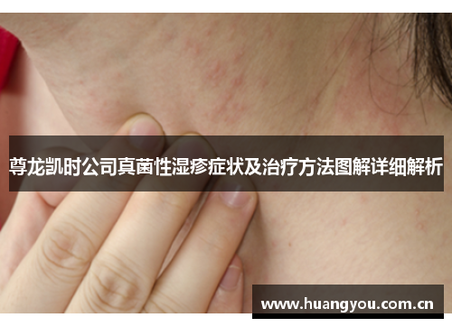 尊龙凯时公司真菌性湿疹症状及治疗方法图解详细解析 尊龙凯时公司真菌性湿疹症状及治疗方法图解详细解析